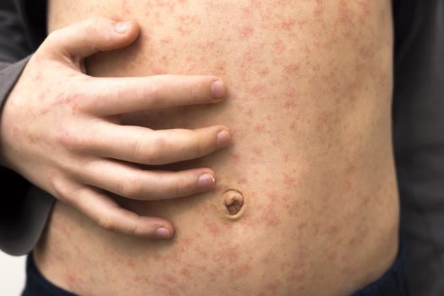 Child's belly with measles rash