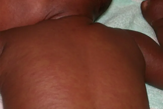 Measles rash on a baby with dark brown skin.
