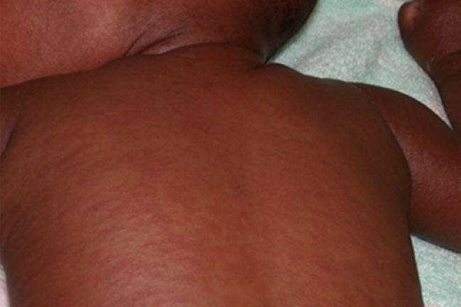 Measles rash on a baby with dark brown skin. 