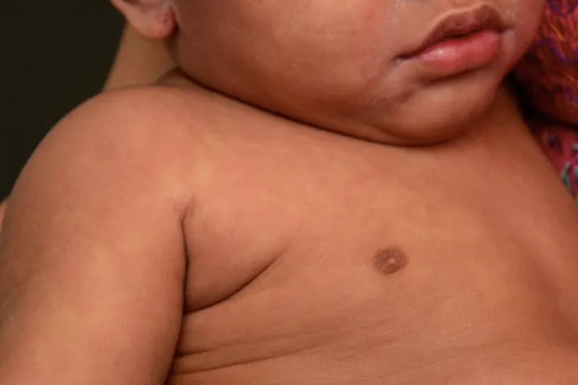 Measles rash on a baby with light brown skin.