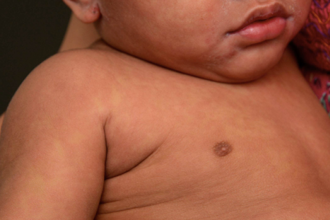 Measles rash on a baby with light brown skin. 