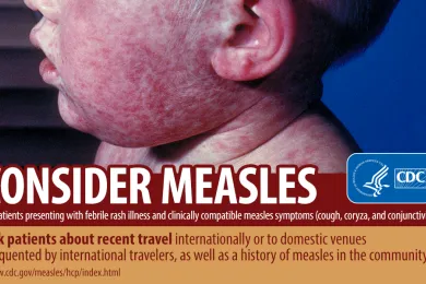 consider measles